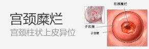 宫颈糜烂